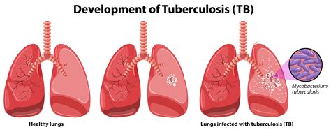 bad tb|Tuberculosis